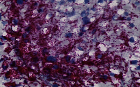 Fusobacterium nucleatum bacteria (purple) in a human colorectal cancer tumor. 