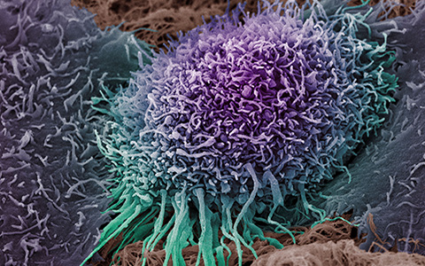 A colorized scanning electron micrograph of a human oral squamous carcinoma cell, the most common form of head and neck cancer. 