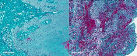 Gum comparison between healthy people and people with periodontal disease.