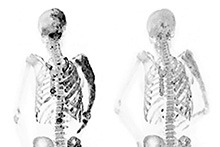 Depiction of the benefits of denosumab when treating fibrous dysplasia