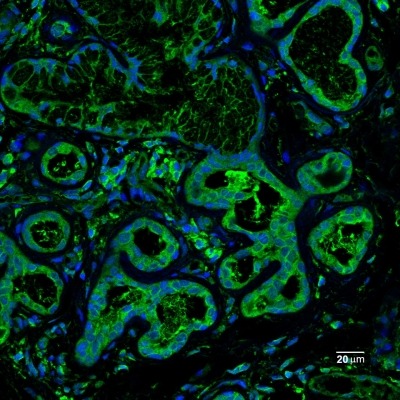 Salivary gland of someone with Sjögren’s Syndrome 